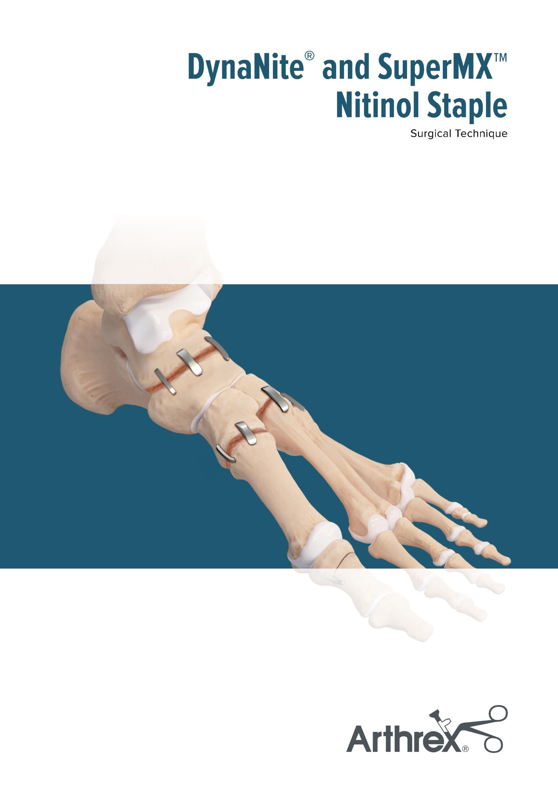 DynaNite and SuperMX Nitinol Staples