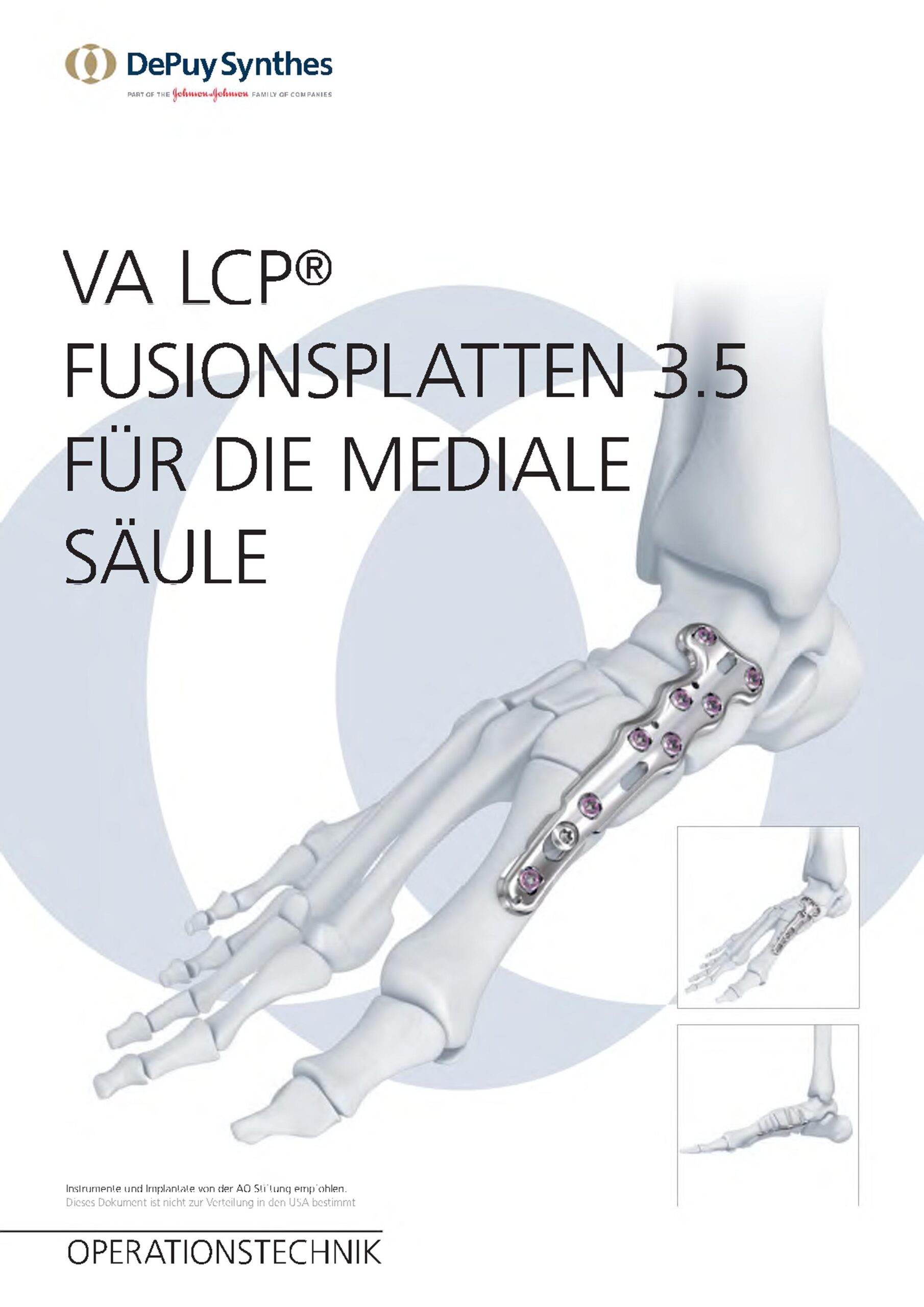 Arthrodéza mediálního sloupce nohy