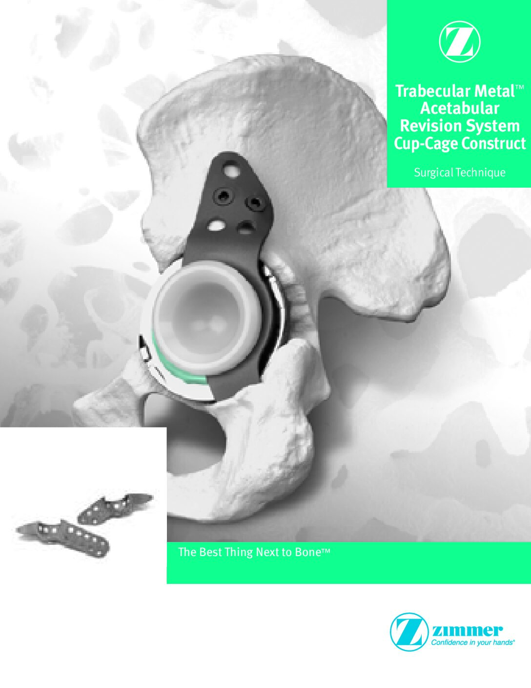 Trabecular metal Acetabular Revision System Cup-Cage Construct